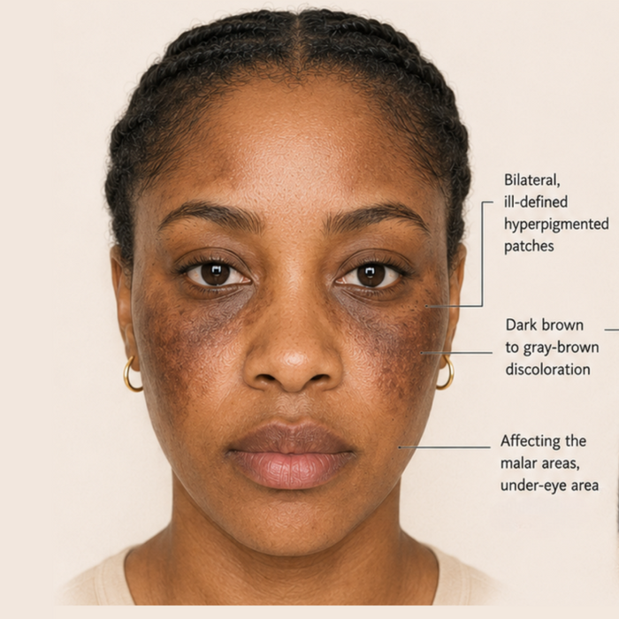 Facial Pigmentary Demarcation Line (FPDL)