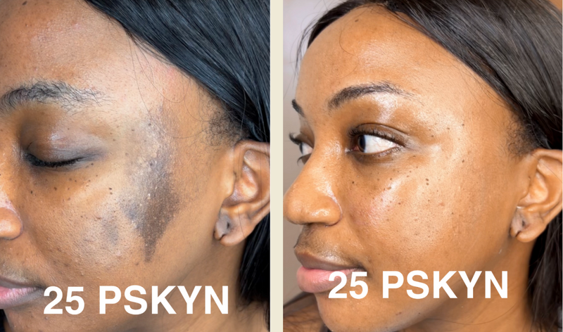 Hyper Pigmentation