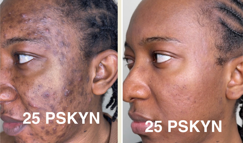ACNE & HYERPIGMENTATION