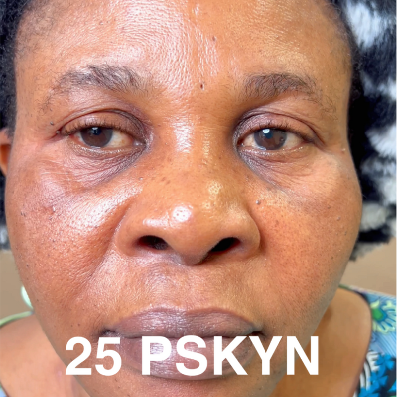 After treatment