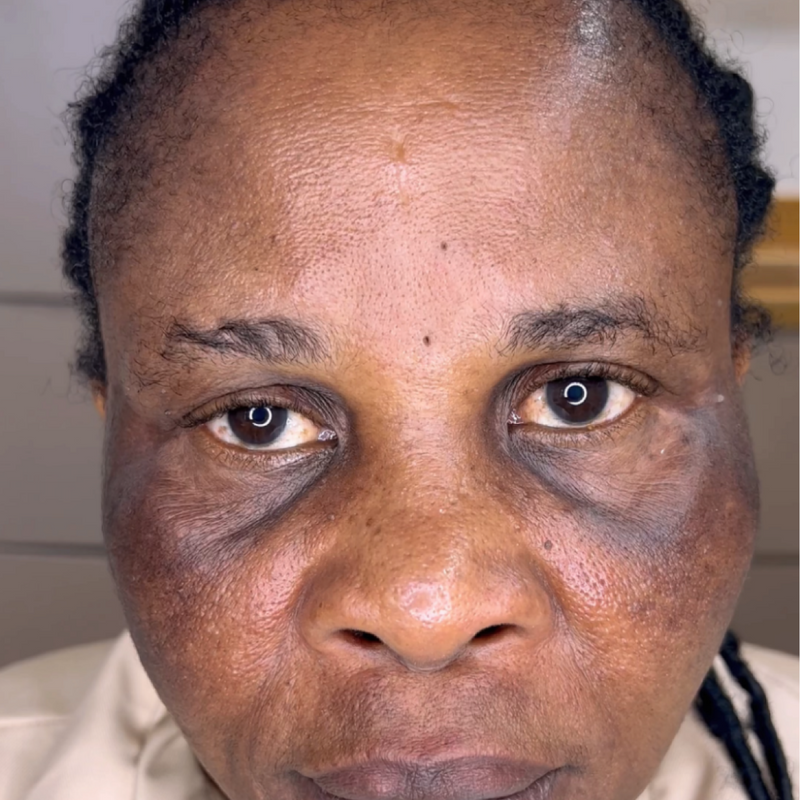 Before treatment