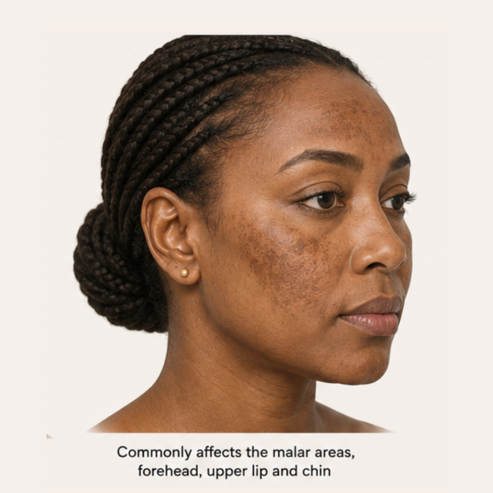 Melasma in Skin of Colour